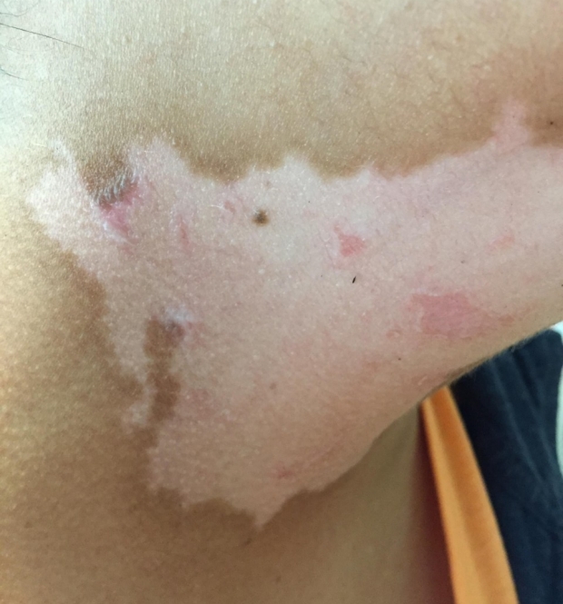 white patch of vitiligo